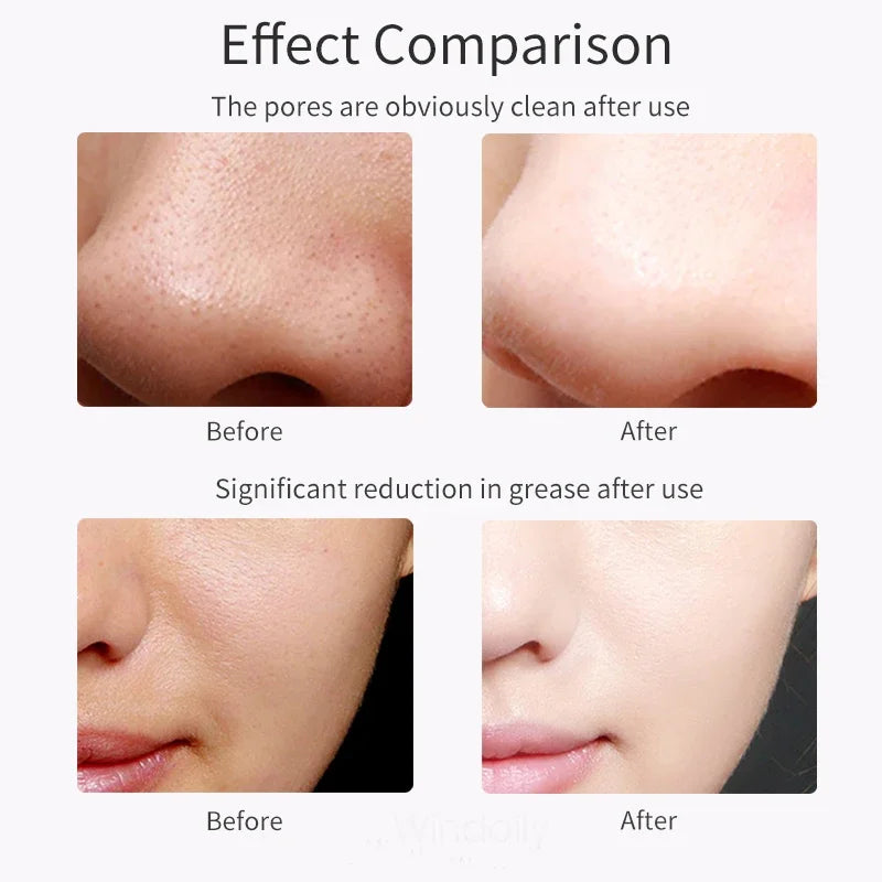 For You™ Cavitation shovel Facial Exfoliation